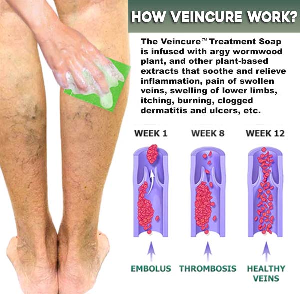 VeinCure™ Varicose-Veins Treatment Soap